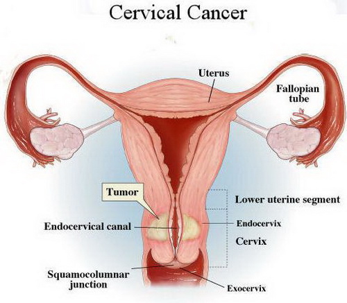 Cervical-Cancer-Picture
