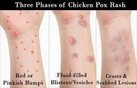 stages of chicken pox