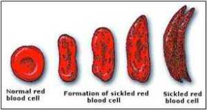 Sickle Cell Disease: What we should know