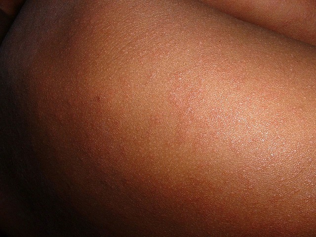 Ministry of Health maintains vigilance amid US Measles outbreak